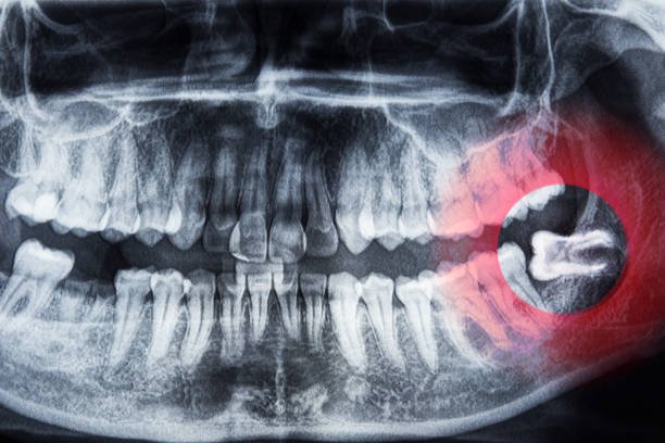 All About Wisdom Teeth: Your Go-to-Guide